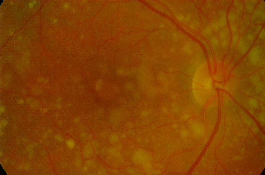 macular degeneration Blackheath Eyecare